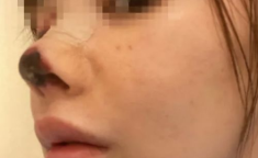 网红清鼻头